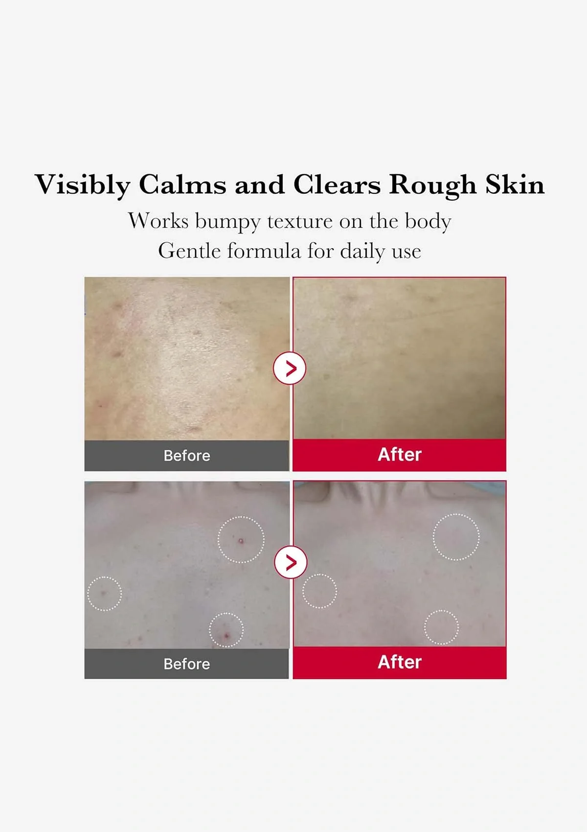 [MEDICUBE] Red Acne Body Peeling Shot Cleanser 110g - Image 6